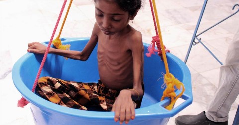 A girl suffering from severe malnutrition is weighed at a hospital in Yemen on Oct. 25. Photo: Essa Ahmed / AFP / Getty Images