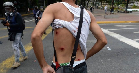 A protester shows his wounded back as riot police clash with opposition demonstrators in Caracas, Wednesday. Photo: Federico Parra / AFP - Getty Images