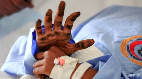 一名也門女孩在首都薩那的一家醫院接受治療，因為在Hajjah省北部空襲期間受傷。